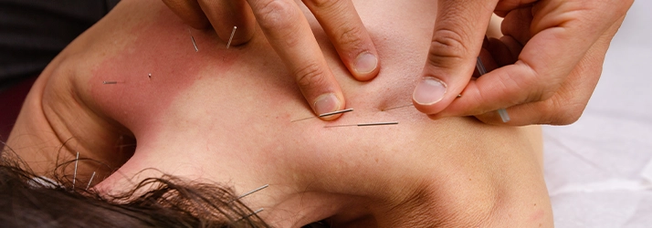 Chiropractic Greenwich CT Woman Receiving Acupuncture Treatment
